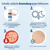An instructional diagram showing the steps for applying a wart treatment. Náhľad obrázku produktu