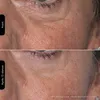 Silk'n FLM100PE1001, Lichttherapie der Haut, Weiß, Produktbild-Vorschau 8