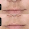 Silk'n FLM100PE1001, Lichttherapie der Haut, Weiß, Produktbild-Vorschau 10