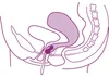 ELANEE 705-00, Kegel-oefenballen, Roze, Wit, Mat, 1 stuk, Productafbeelding-voorbeeld 4