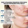 Zinksalbe gegen Pickel | Produktbild-Vorschau 2