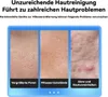 Mitesser Entferner Elektrisch, Porensauger mit sichtbarem Produktbild-Vorschau 5