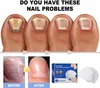 Laserbasierte Nagelpilzbehandlung – Purenail USB - Produktbild-Vorschau 7