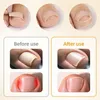 Teennagelcorrectiepleisters, 110 stuks, ademend, Productafbeelding-voorbeeld 6