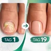 PODOclip™ LLLT Nagelpilztherapie Nagelpilz Laser Behandlung Produktbild-Vorschau 5