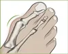 Merkloos Hallux Valgus Zehenspreizer Produktbild-Vorschau 4