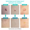 Stielwarzen Entferner Skin Tag 2in1 Removal Set Anti Produktbild-Vorschau 8