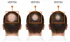 Haarwuchs-Schaum, Foligain, 5 % Minoxidil, parfümfrei, 2 x Produktbild-Vorschau 2