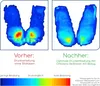 Two pressure distribution maps comparing before and after using a seat cushion. Produktbild-Vorschau