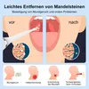 Tonsillenstein Entferner​,Mandelstein Entferner Mit Produktbild-Vorschau 4