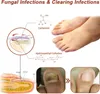 Urządzenie do terapii światłem South Moon Nail Fungus Lampa Podgląd zdjęcia produktu 7