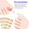 Wellife Náplasti proti zarastaniu nechtov 100 ks Náhľad obrázku produktu 3