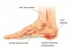 Orthopädische Schuheinlagen bei Fersensporn und Produktbild-Vorschau 4