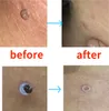 Zestaw do usuwania brodawek Skin Tag Remover Skin Tag Podgląd zdjęcia produktu 9
