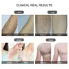 Profesionální laserový odstraňovač chloupků IPL, systém Náhled obrázku produktu 7