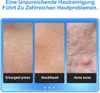Elektrischer Mitesser-Entferner & Gesichtsbürste, Produktbild-Vorschau 7