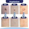 Paremmin 2-in-1 Stielwarzen Entfernen Kit (40 Stück) – Für Produktbild-Vorschau 6