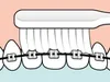 5x Tepe Zahnspangenbürste - Implant/Orthodontic Produktbild-Vorschau 4