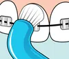 A close-up illustration of a toothbrush with blue toothpaste being used to clean teeth with braces. Produktbild-Vorschau