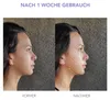 Before and after comparison of a woman's face, highlighting skin tightening effects. Produktbild-Vorschau