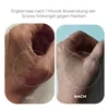A side-by-side comparison of a hand before and after using a scar treatment gel. Anteprima dell’immagine prodotto