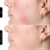 Silk'n FLM100PE1001, Lichttherapie der Haut, Weiß, Produktbild-Vorschau 11