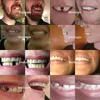 Smilogic Set de dents provisoires Remplacer facilement une Voir les images du produit 3