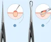 INF Mitesserentferner-Set - 2-teiliges Set zum Entfernen Produktbild-Vorschau 5