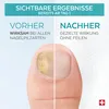 PODERM NAGELPILZ BEHANDLUNG regeneriert/repariert Produktbild-Vorschau 9