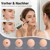 Warzen- und Muttermal Entferner Stift, 99 Stufen Produktbild-Vorschau 3