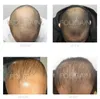 Haarwuchs-Schaum, Foligain, 5 % Minoxidil, parfümfrei, 2 x Produktbild-Vorschau 3