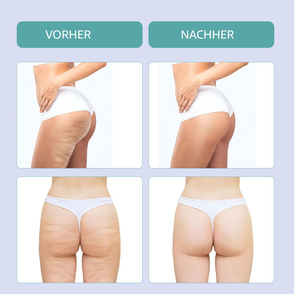 GESS EMIOS EMS Körpermassagegerät gegen Cellulite mit Produktbild 4
