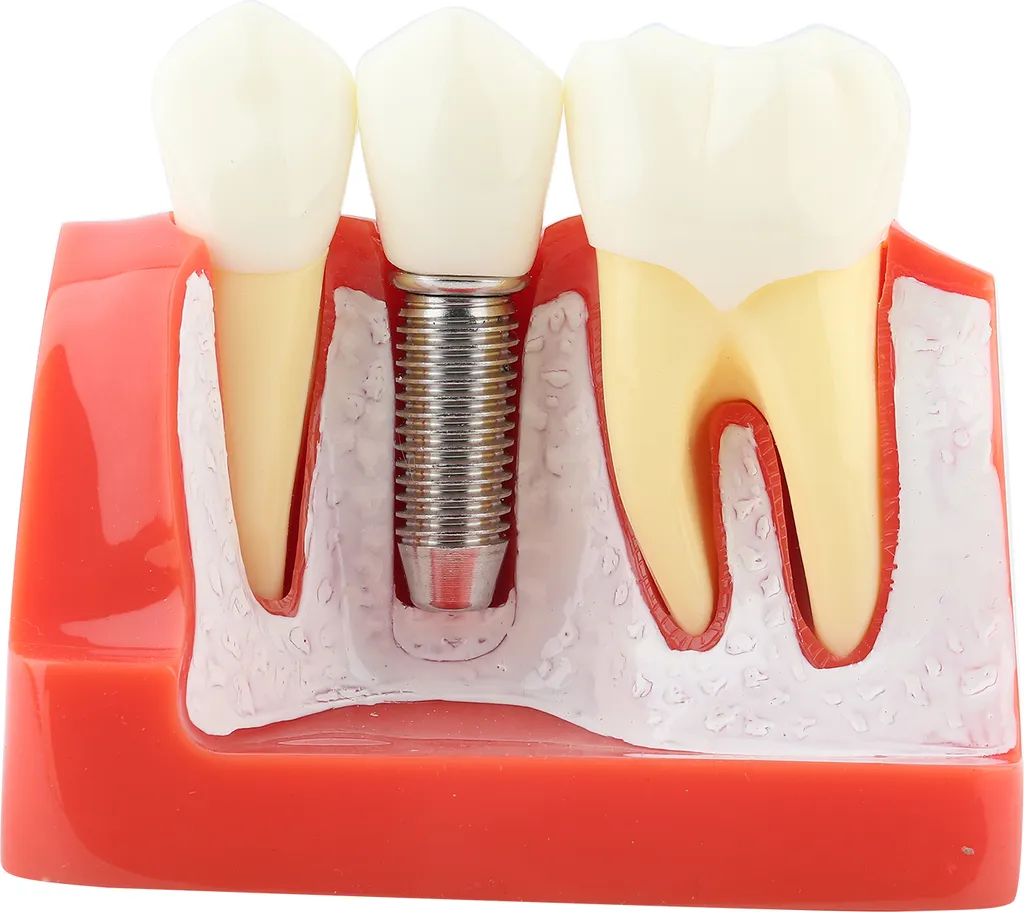 Modèle d'implantologie en résine avec couronne et bridge pour dentiste