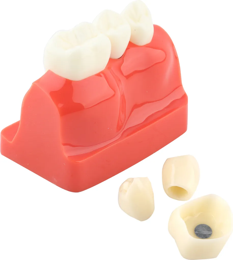 Maquette dentaire de démonstration pour implants et ponts de précision - 3