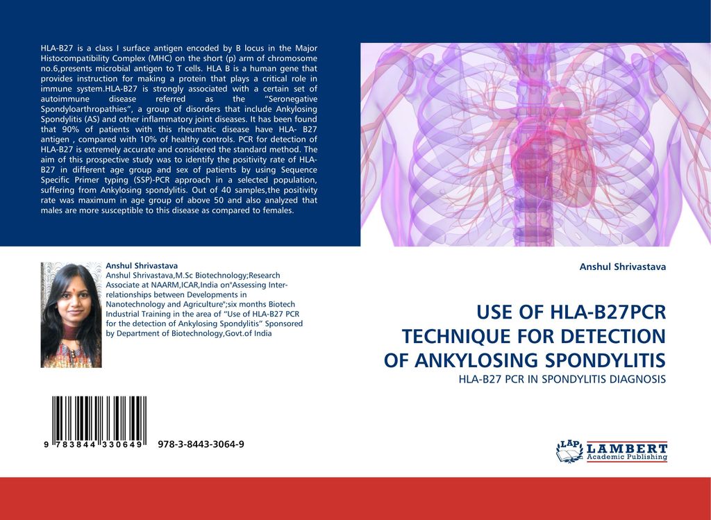 Use Of Hla-B27Pcr Technique For Detection Of Ankylosing Spondylitis