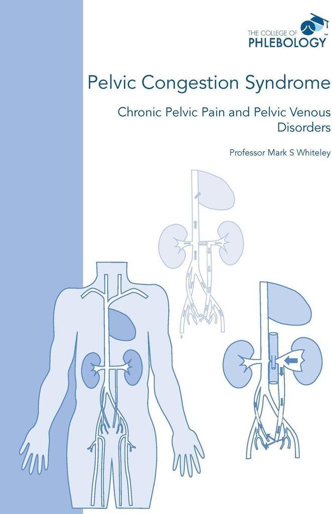 Pelvic Congestion Syndrome - Chronic Pelvic Pain and Pelvic Venous Disorders