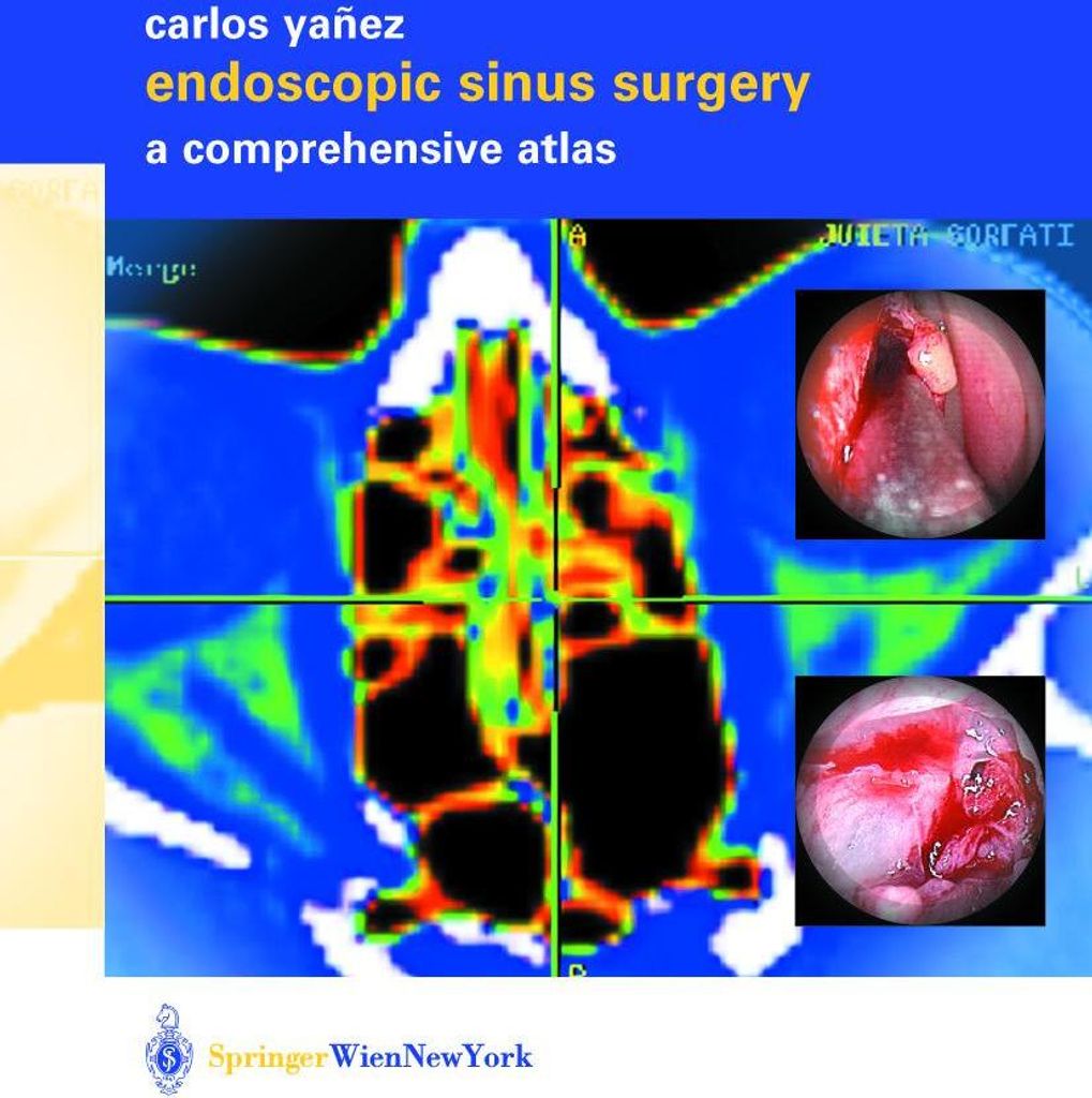 Endoscopic Sinus Surgery