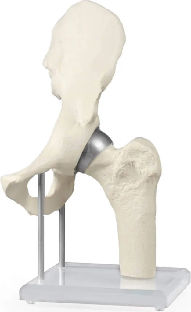 Articulation hanche et prothèse : aide pédagogique pour l'orthopédie