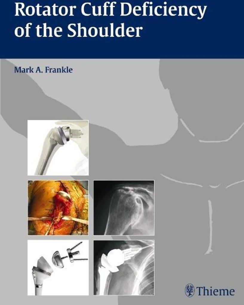 Rotatorenmanschettendefekt an der Schulter