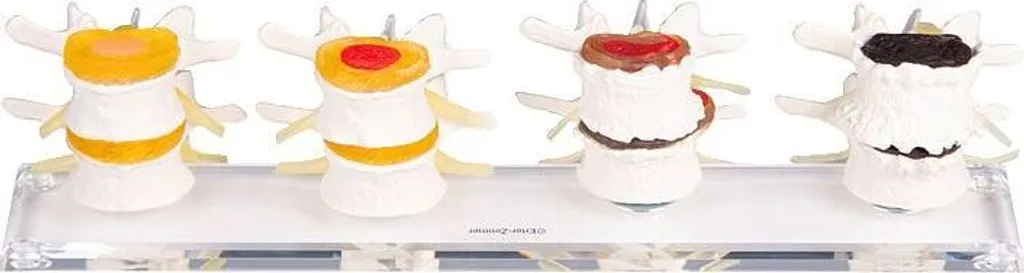 Maquette de colonne vertébrale Erler-Zimmer pour pathologie discale
