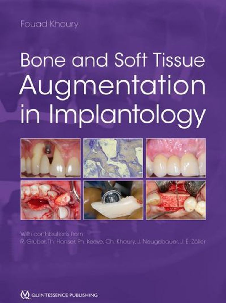Bone and Soft Tissue Augmentation in Implantology Obrázek produktu 