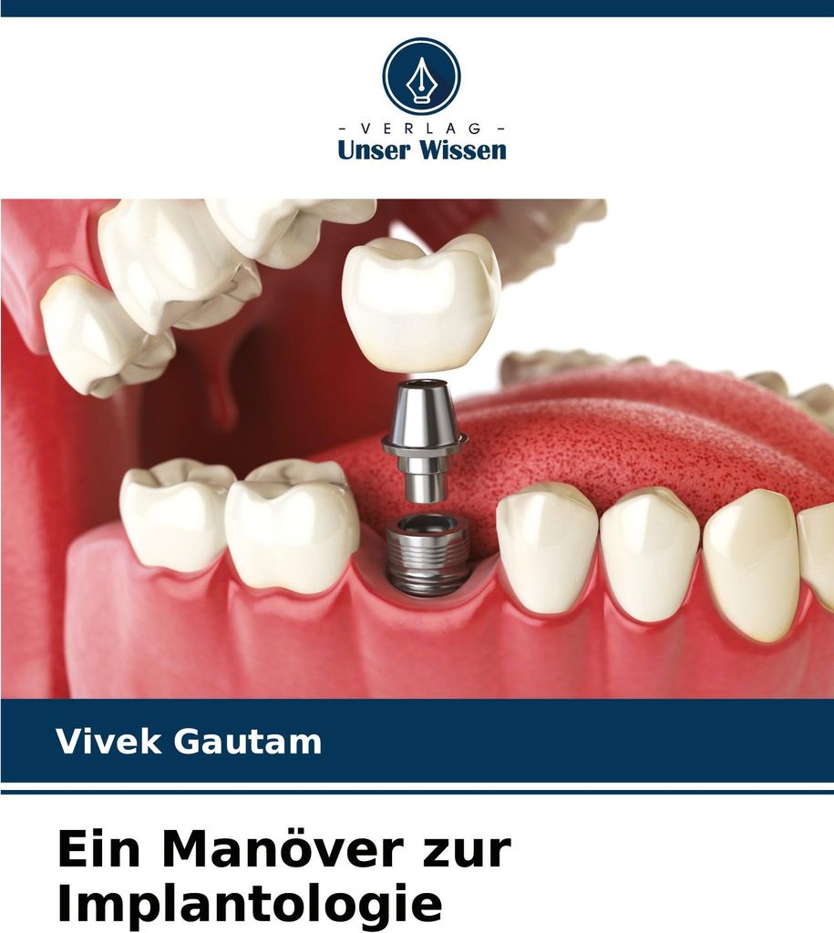 Ein Manöver zur Implantologie