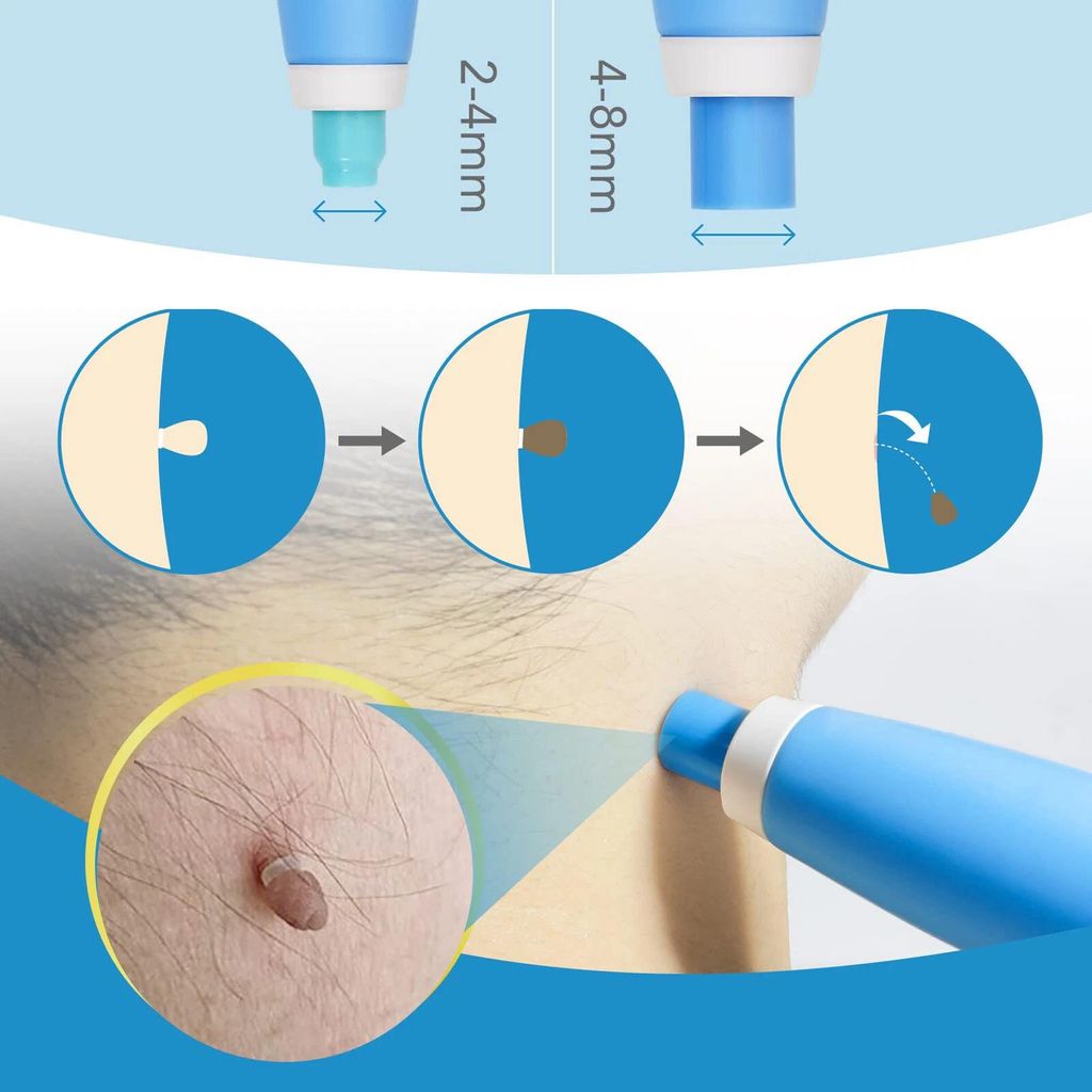 Stielwarzen Entferner, Skin Tag Entferner,2-in-1 Produktbild 