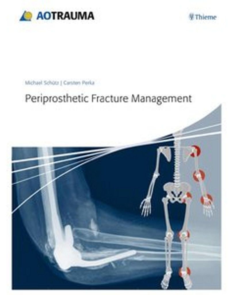 Periprosthetic Fracture Management