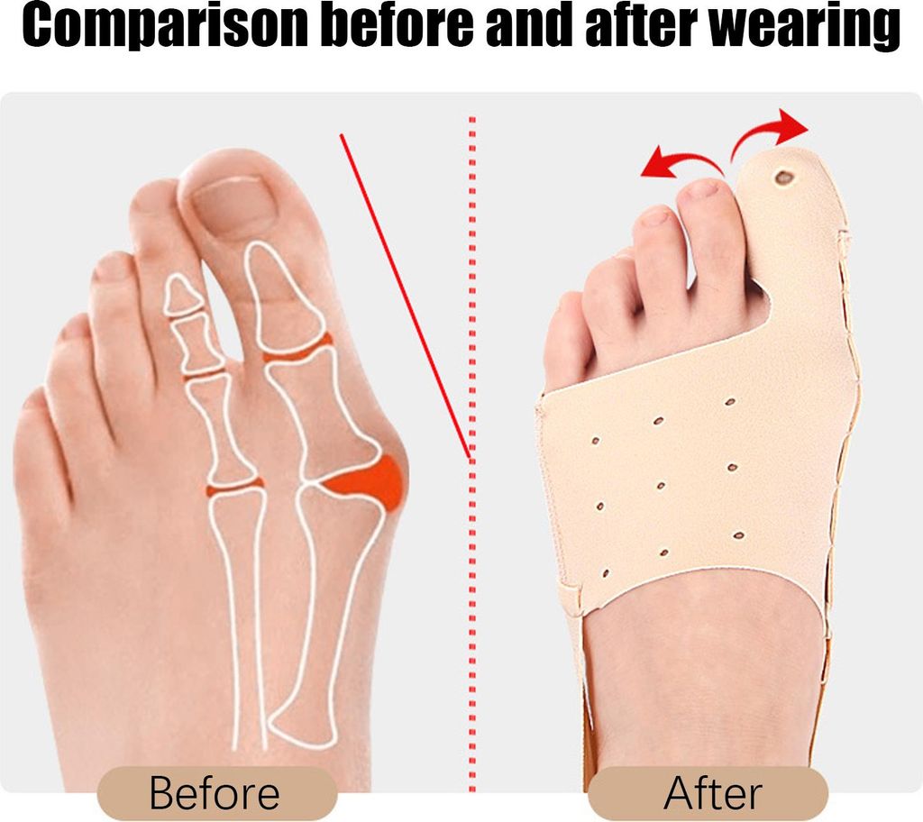 Correttore Per Alluce Valgo (bunion) Regolabile – Per Donne E Uomini, Con Pulsante Di Inclinazione, Neoprene Traspirante, Lavabile - 3