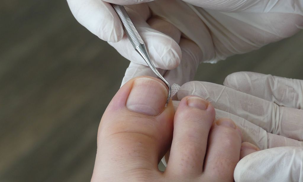 K-Pro Nagelfeile Für Eingewachsene Zehennägel – Doppelseitige Podologie-Feile Für Zuhause