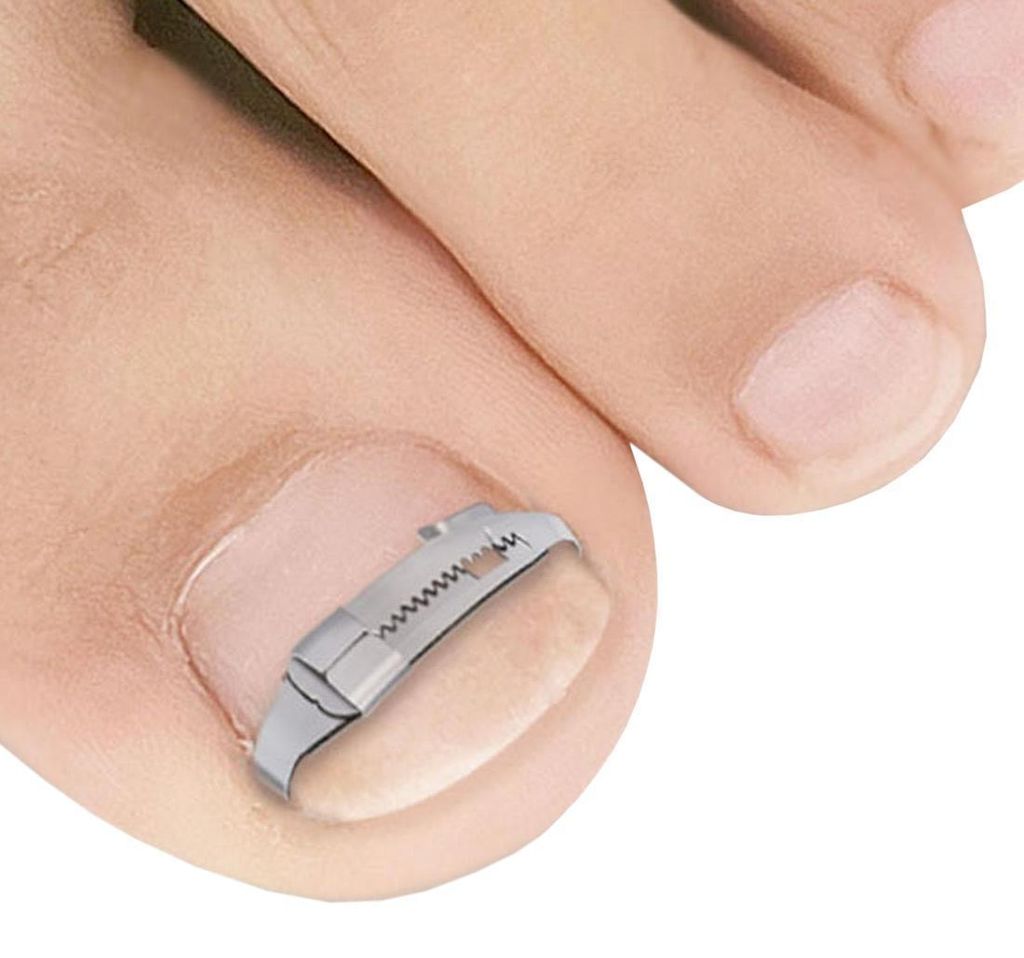 Nagelclip für eingewachsene Zehennägel Produktbild 