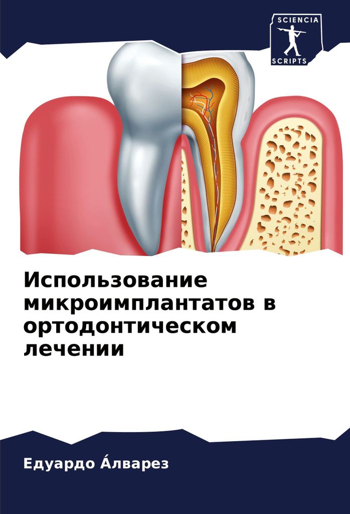 Ispol'zowanie mikroimplantatow w ortodonticheskom lechenii