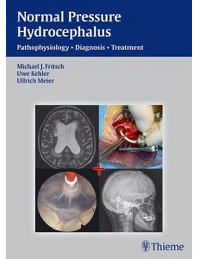 NPH - Normal Pressure Hydrocephalus