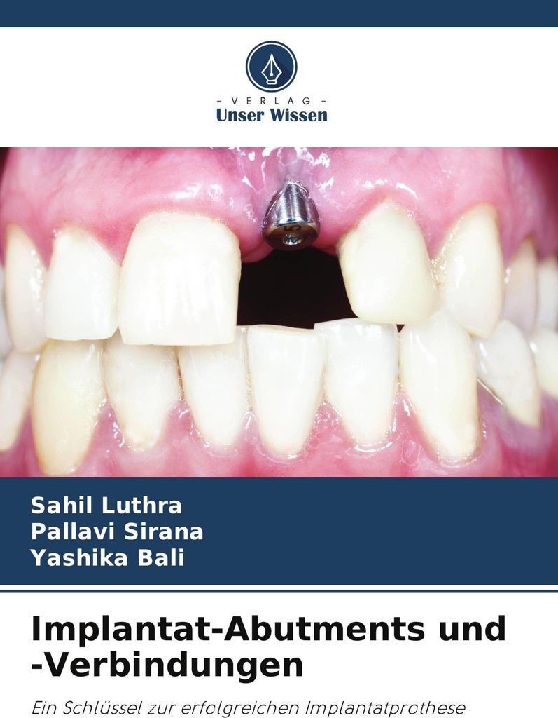 Implantat-Abutments und -Verbindungen